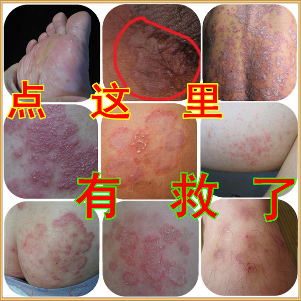 癬腳臭腳汗水泡大腿內側皮膚瘙癢止癢膏過敏脫皮治腳氣王膏牛皮蘚