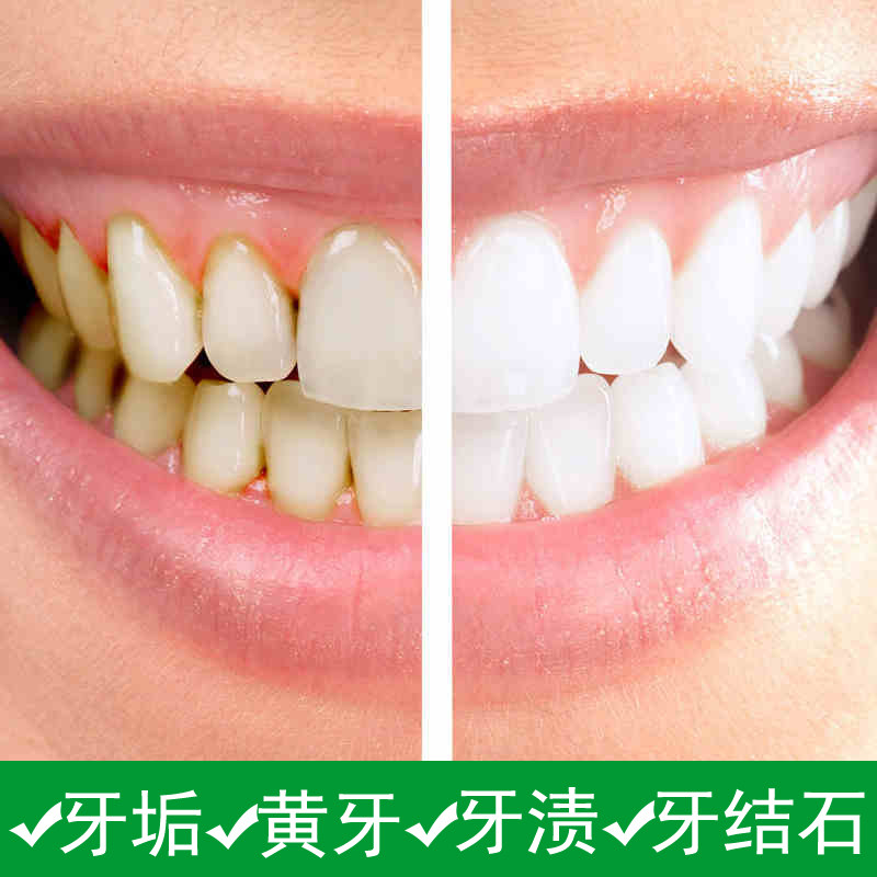 洗牙粉去黄牙烟渍牙渍去牙结石洁牙素50g