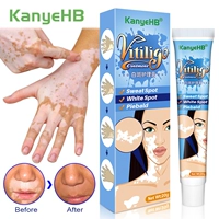 .20g Herbal Extract Vitiligo Ointment Remove Ringworm White
