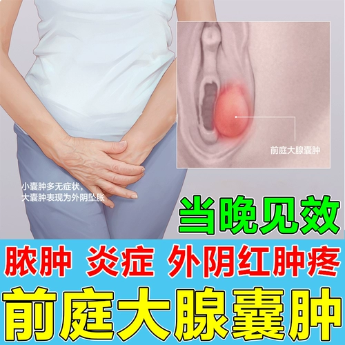 Зарубежные железы Barlin Cysts Sparse Drugs для лечения опухолей женщин вульвы и опухшего больного гинекологического геля