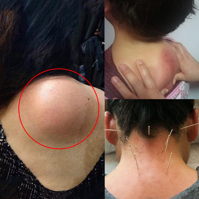 富贵包消除贴颈椎疼痛专用贴膏腰间盘特效颈部疏通肩颈热敷贴正品